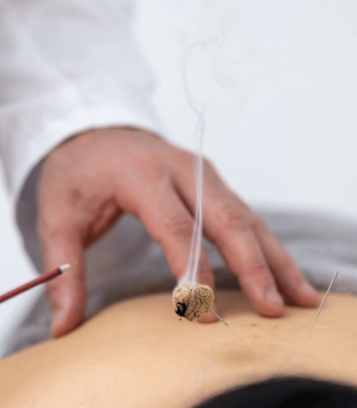 Dr Robert Navacchi moxibustion